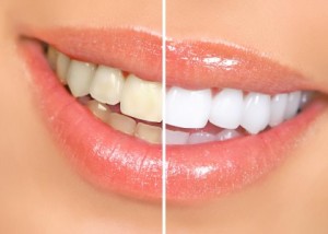 Как отбелить зубы без вреда для эмали в домашних условиях