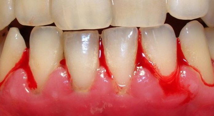 Болезни зубов и дёсен Болезни зубов и дёсен