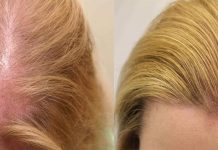 Препараты, вызывающие алопецию или изменяющие цвет волос Препараты, вызывающие алопецию или изменяющие цвет волос