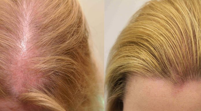 Препараты, вызывающие алопецию или изменяющие цвет волос Препараты, вызывающие алопецию или изменяющие цвет волос