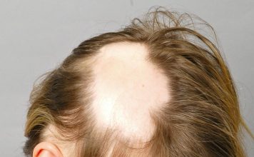 Что делать если волосы на голове начинают выпадать? Что делать если волосы на голове начинают выпадать?