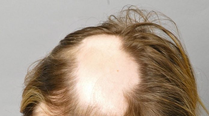 Что делать если волосы на голове начинают выпадать? Что делать если волосы на голове начинают выпадать?