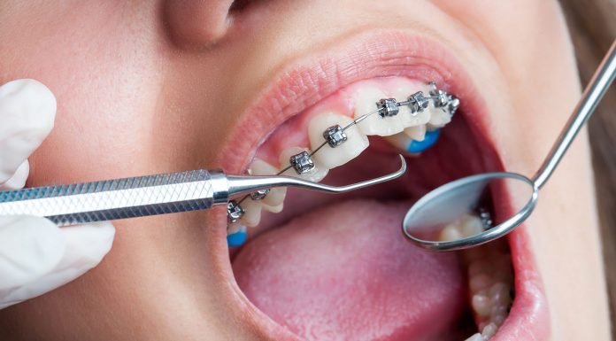 Установка брекетов Установка брекетов