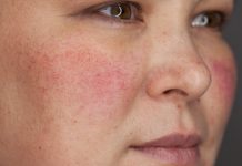 Купероз: причины и лечение Купероз: причины и лечение