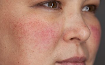 Купероз: причины и лечение Купероз: причины и лечение