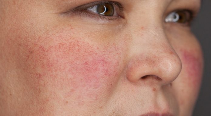 Купероз: причины и лечение Купероз: причины и лечение