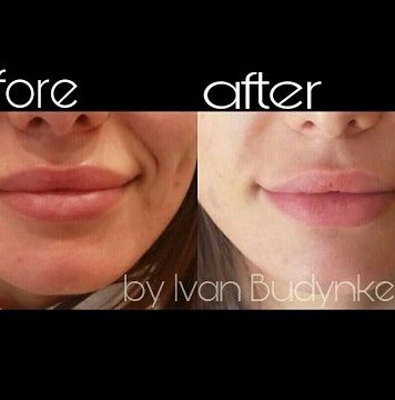 Как проходит коррекция носогубных складок гиалуроновой кислотой