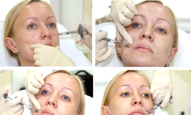 Носогубные складки гиалуроновой кислотой: противопоказания, последствия, фото и отзывы