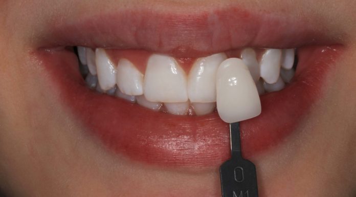 Отбеливание ZOOM 4 в Новосибирске в «Стоматике» Отбеливание ZOOM 4 в Новосибирске в "Стоматике"