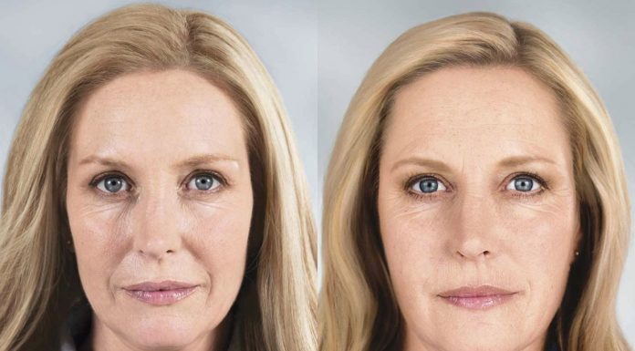 Носогубные складки: филлеры и чем они могут быть вредны?