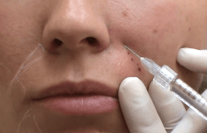 Филлеры в носогубки: техника введения, сколько держится результат, последствия