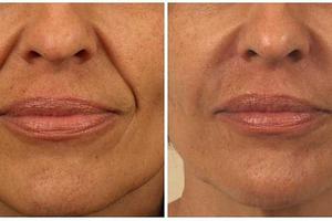 Гиалуроновая кислота для коррекции носогубных складок: фото до и после, сколько стоит укол, отзывы пациентов
