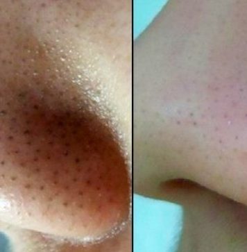 Черные точки. Средства для их устранения Черные точки. Средства для их устранения