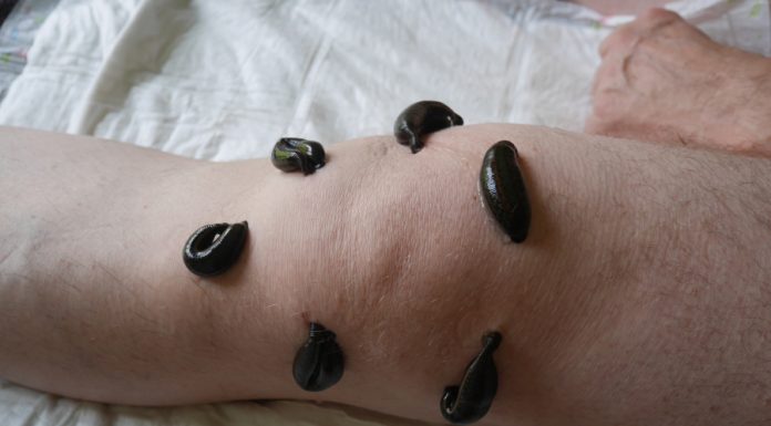 Лечение артроза суставов пиявками Лечение артроза суставов пиявками