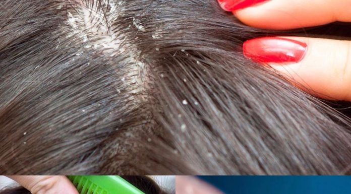 Педикулез: заболевание, с которым сталкивается каждый третий человек