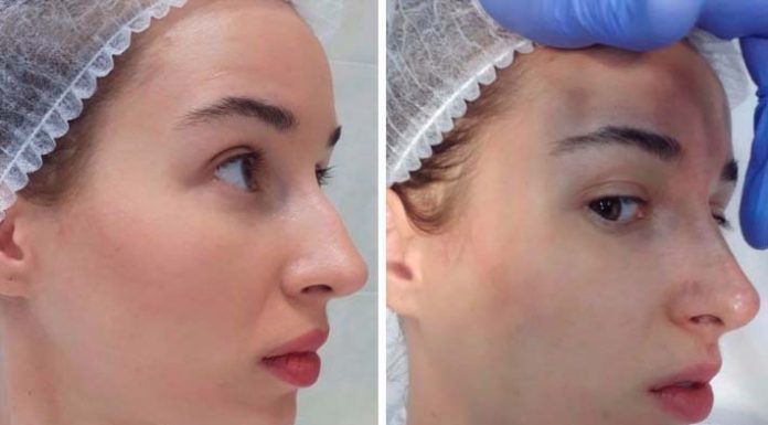 Эффект безоперационной ринопластики Эффект безоперационной ринопластики