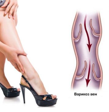 Что принимать при варикозном расширении вен?