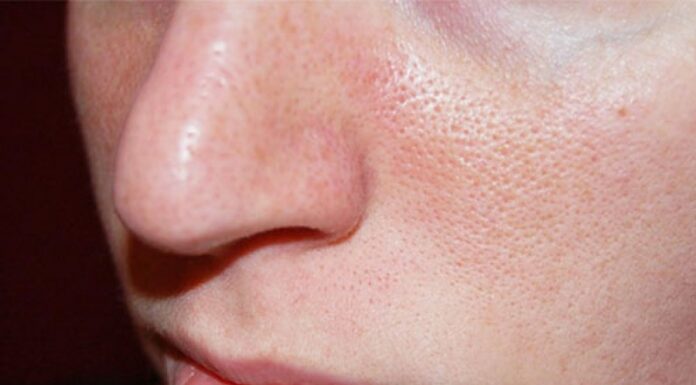 Расширенные поры: эффективные методы борьбы