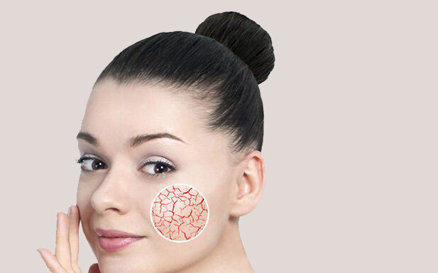 Удаление сосудистых звездочек лазером